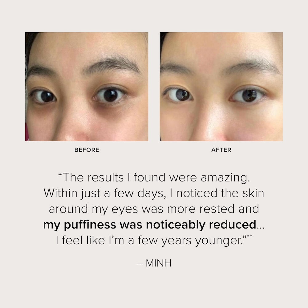 Before and after comparison of eye area with testimonial from real user Minh who says: The results I found were amazing. Within just a few days, I noticed the skin around my eyes was more rested and my puffiness was noticeably reduced... I feel like I'm a few years younger. 