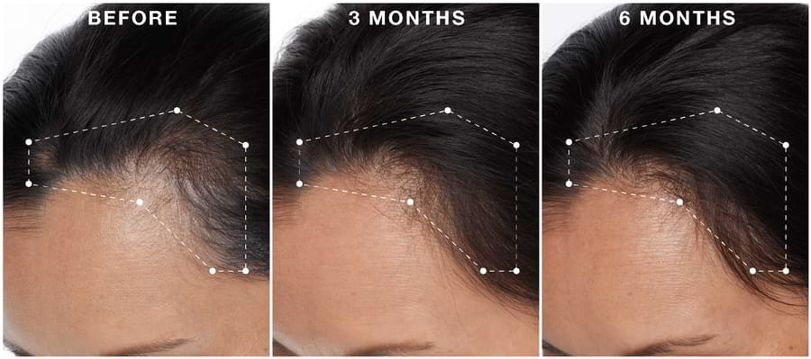 Hair Regeneres ADVANCED user before and after photos.