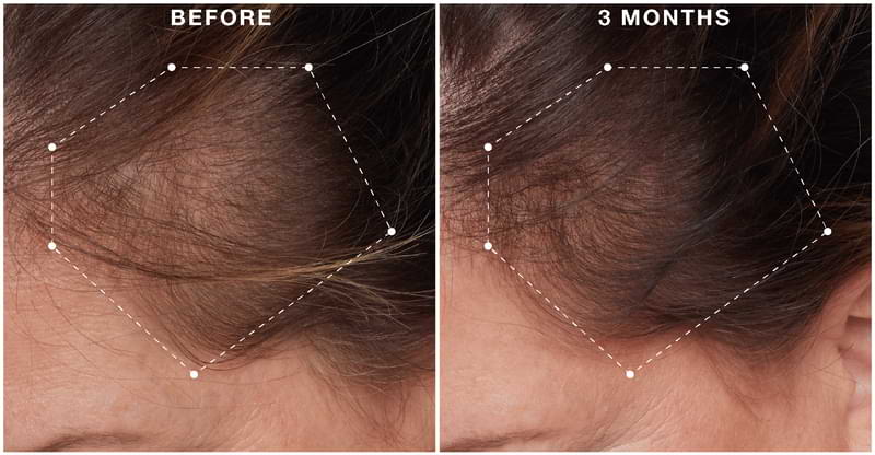 Hair Regeneres ADVANCED user before and after photos.