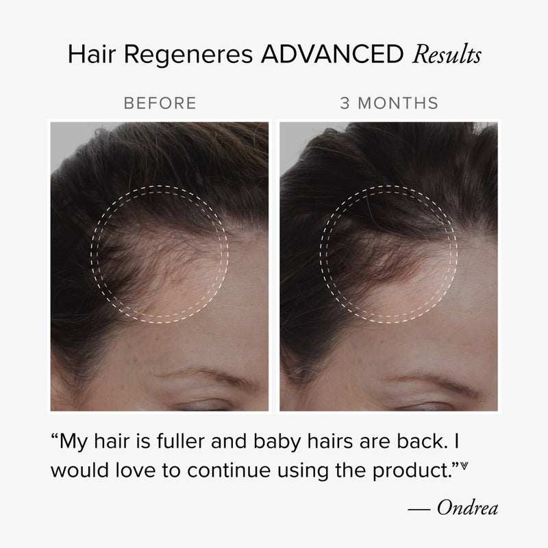 Before and after comparison of 3 months showing hair regrowth from Hair Regeneres ADVANCED with testimonial from user named Ondrea.